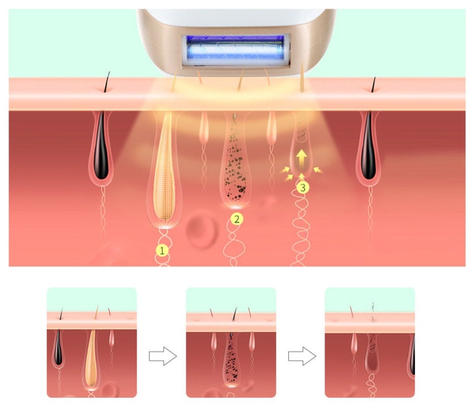 NovaPulse IPL Laser-Haarentfernungsgerät für den Heimgebrauch und die tägliche Körperpflege