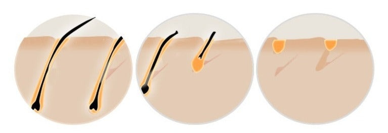 At-Home IPL Hair Removal Device | Best at Home Laser Hair Removal for Smooth Skin 4